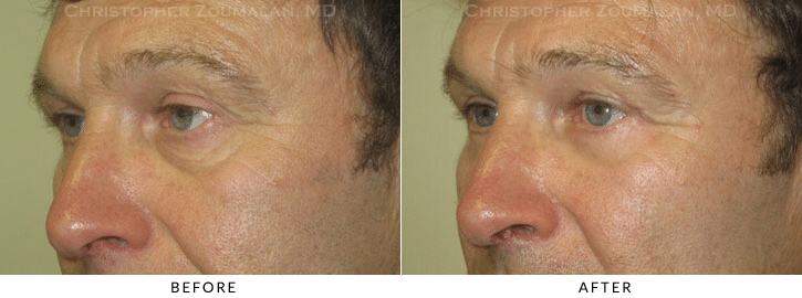 Lower Lid Blepharoplasty Before & After Photo - Patient Seeing Side - Patient 67B