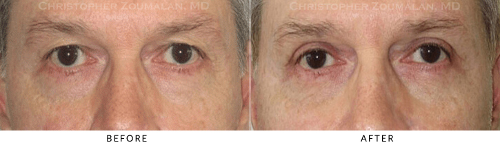 Lower Lid Blepharoplasty Before & After Photo -  - Patient 68A
