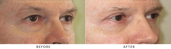 Lower Lid Blepharoplasty Before & After Photo -  - Patient 68B