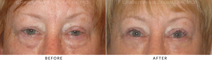 Lower Lid Blepharoplasty Before & After Photo -  - Patient 69