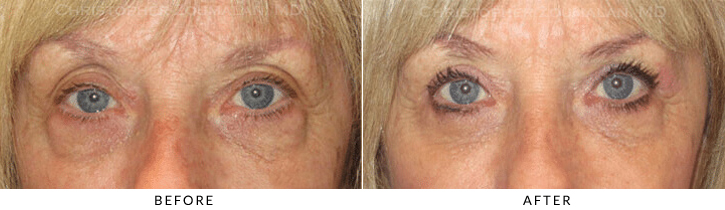 Lower Lid Blepharoplasty Before & After Photo - Patient Seeing Straight - Patient 70A