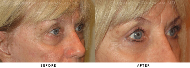 Lower Lid Blepharoplasty Before & After Photo - Patient Seeing Side - Patient 70C