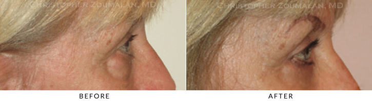 Lower Lid Blepharoplasty Before & After Photo - Patient Seeing Side - Patient 70B