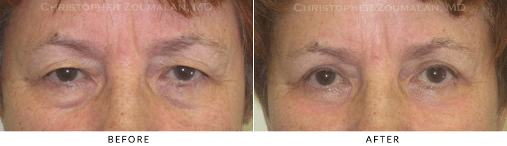 Lower Lid Blepharoplasty Before & After Photo -  - Patient 72