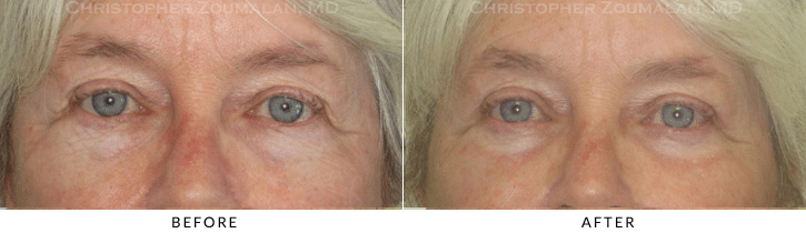 Lower Lid Blepharoplasty Before & After Photo -  - Patient 68