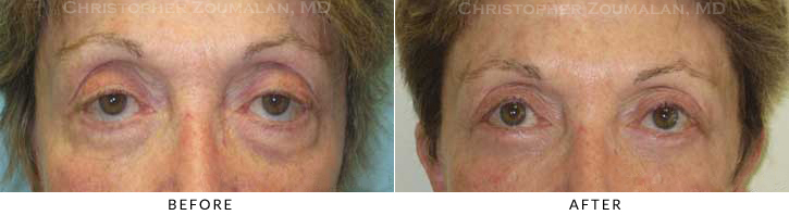 Lower Lid Blepharoplasty Before & After Photo -  - Patient 74