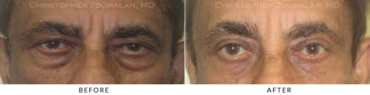 Lower Lid Blepharoplasty Before & After Photo -  - Patient 70