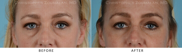 Lower Lid Blepharoplasty Before & After Photo - Patient Seeing Straight - Patient 12A