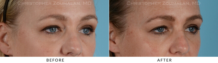 Lower Lid Blepharoplasty Before & After Photo -  - Patient 12C