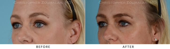 Lower Lid Blepharoplasty Before & After Photo - Patient Seeing Side - Patient 12D