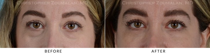 Lower Lid Blepharoplasty Before & After Photo - Patient Seeing Straight - Patient 18A