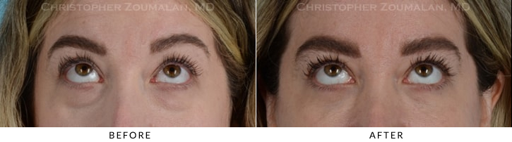 Lower Lid Blepharoplasty Before & After Photo - Patient Seeing Up - Patient 18D