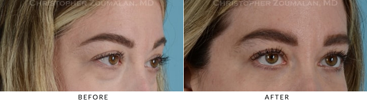 Lower Lid Blepharoplasty Before & After Photo -  - Patient 18C