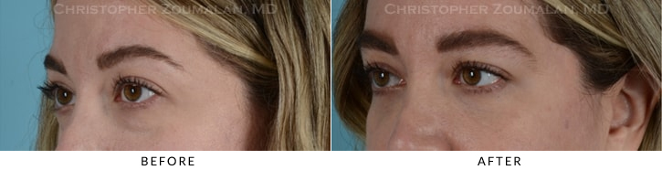 Lower Lid Blepharoplasty Before & After Photo - Patient Seeing Side - Patient 18B