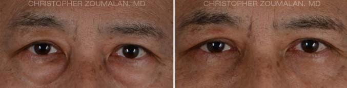 Lower eyelid blepharoplasty Front View