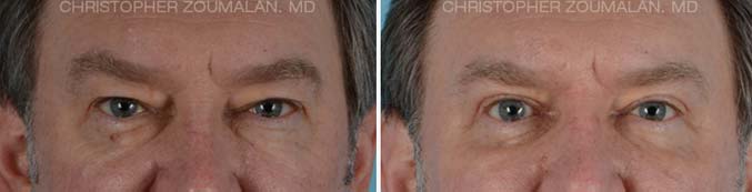 Lower eyelid blepharoplasty Front View