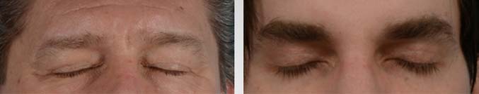 A male blepharoplasty procedure is performed with the utmost precision and care to ensure minimal scarring - male patient before and after picture