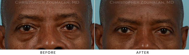 Male Blepharoplasty Before & After Photo - Patient Seeing Straight - Patient 15A