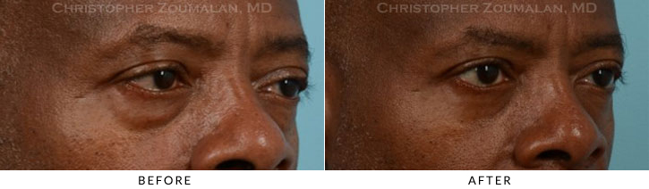 Male Blepharoplasty Before & After Photo - Patient Seeing Side - Patient 15B