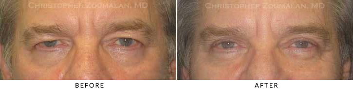 Male Blepharoplasty Before & After Photo -  - Patient 16
