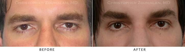 Male Blepharoplasty Before & After Photo -  - Patient 17