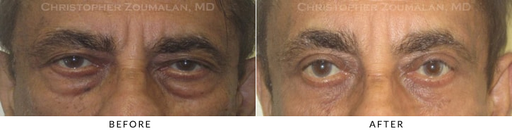 Male Blepharoplasty Before & After Photo -  - Patient 18
