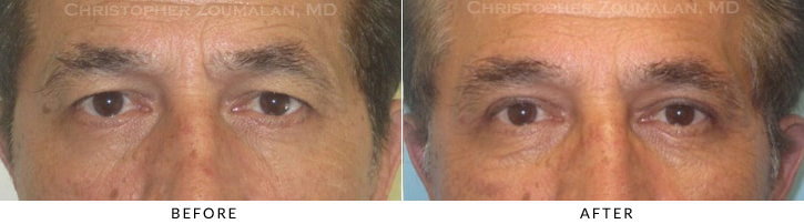Male Blepharoplasty Before & After Photo - Patient Seeing Straight - Patient 20A
