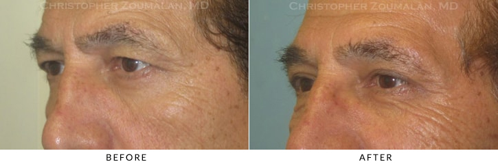 Male Blepharoplasty Before & After Photo - Patient Seeing Side - Patient 20B