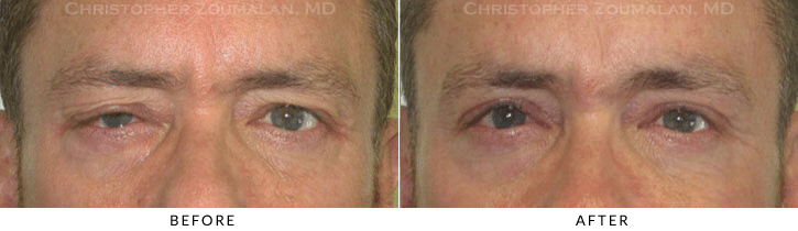 Male Blepharoplasty Before & After Photo -  - Patient 21