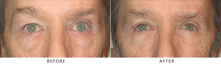 Male Blepharoplasty Before & After Photo -  - Patient 22