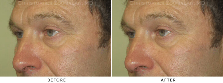 Male Blepharoplasty Before & After Photo - Patient Seeing Side - Patient 24A