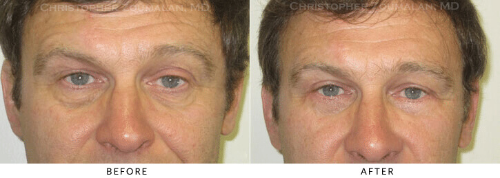 Male Blepharoplasty Before & After Photo - Patient Seeing Straight - Patient 24B