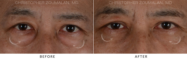 Male Blepharoplasty Before & After Photo - Patient Seeing Straight - Patient 1A