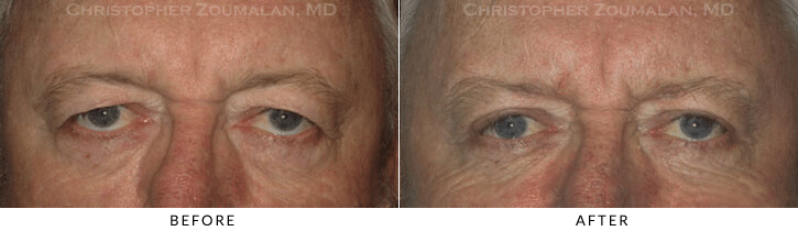 Male Blepharoplasty Before & After Photo -  - Patient 26