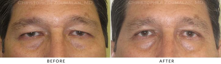 Male Blepharoplasty Before & After Photo -  - Patient 25