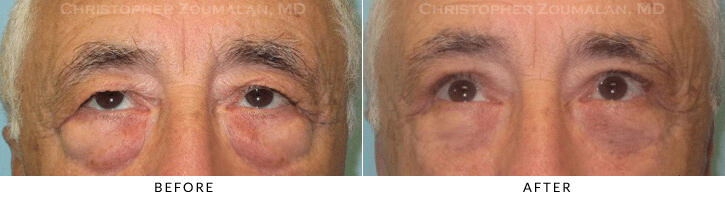 Male Blepharoplasty Before & After Photo - Patient Seeing Up - Patient 27C