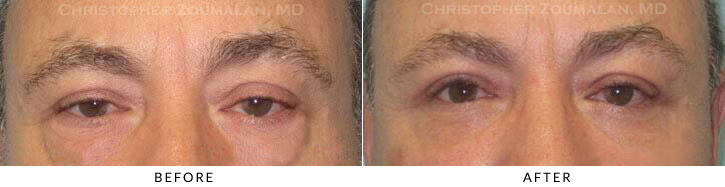 Male Blepharoplasty Before & After Photo - Patient Seeing Straight - Patient 28A