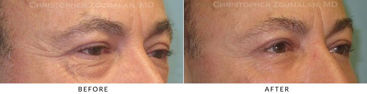 Male Blepharoplasty Before & After Photo - Patient Seeing Side - Patient 28B