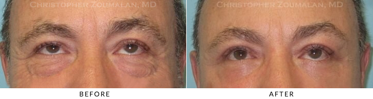 Male Blepharoplasty Before & After Photo - Patient Seeing Up - Patient 28C