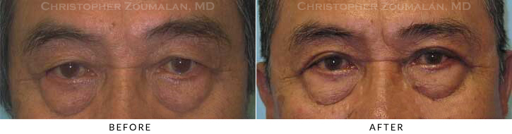 Male Blepharoplasty Before & After Photo -  - Patient 29