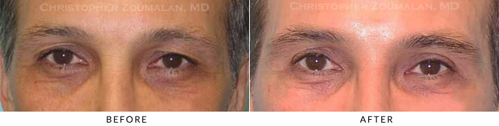 Male Blepharoplasty Before & After Photo -  - Patient 30