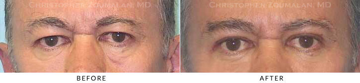 Male Blepharoplasty Before & After Photo - Patient Seeing Straight - Patient 31A