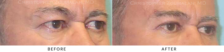 Male Blepharoplasty Before & After Photo - Patient Seeing Side - Patient 31B