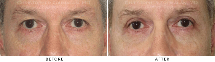 Male Blepharoplasty Before & After Photo - Patient Seeing Straight - Patient 32A