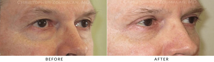 Male Blepharoplasty Before & After Photo - Patient Seeing Side - Patient 32B