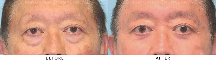 Male Blepharoplasty Before & After Photo -  - Patient 33