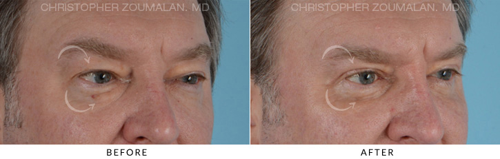 Male Blepharoplasty Before & After Photo - Patient Seeing Side - Patient 2A