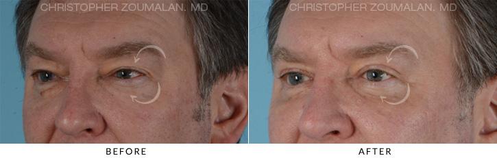 Male Blepharoplasty Before & After Photo - Patient Seeing Side - Patient 7B