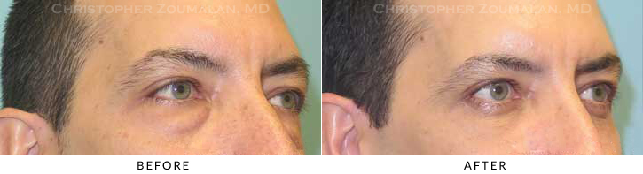Male Blepharoplasty Before & After Photo - Patient Seeing Side - Patient 36A