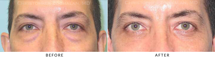 Male Blepharoplasty Before & After Photo - Patient Seeing Straight - Patient 36B
